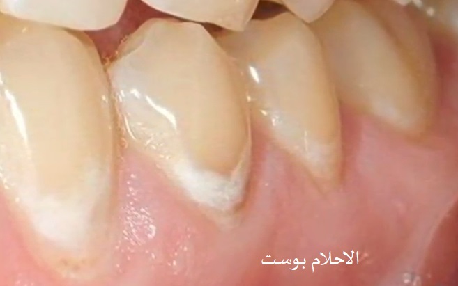 علاج تسوس الاسنان 