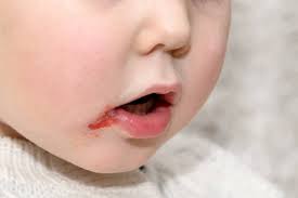 أعراض الإصابة بهربس الفم عند الأطفال