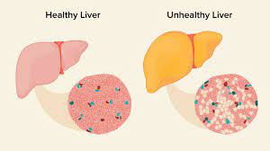 انواع مرض الكبد الدهني