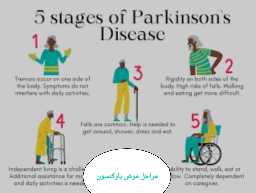 مراحل مرض الباركنسون